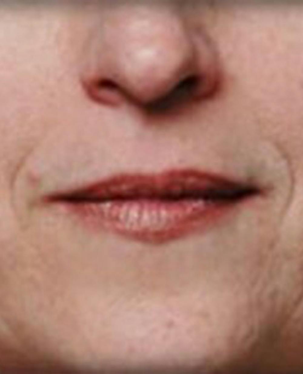Lip Filler Before & After Gallery - Patient 870644 - Image 1