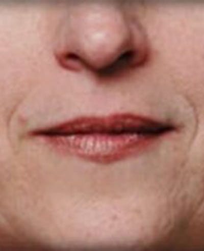 Lip Filler Before & After Gallery - Patient 870644 - Image 1