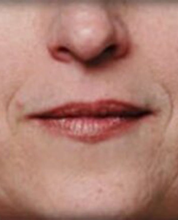 Lip Filler Before & After Gallery - Patient 870644 - Image 1