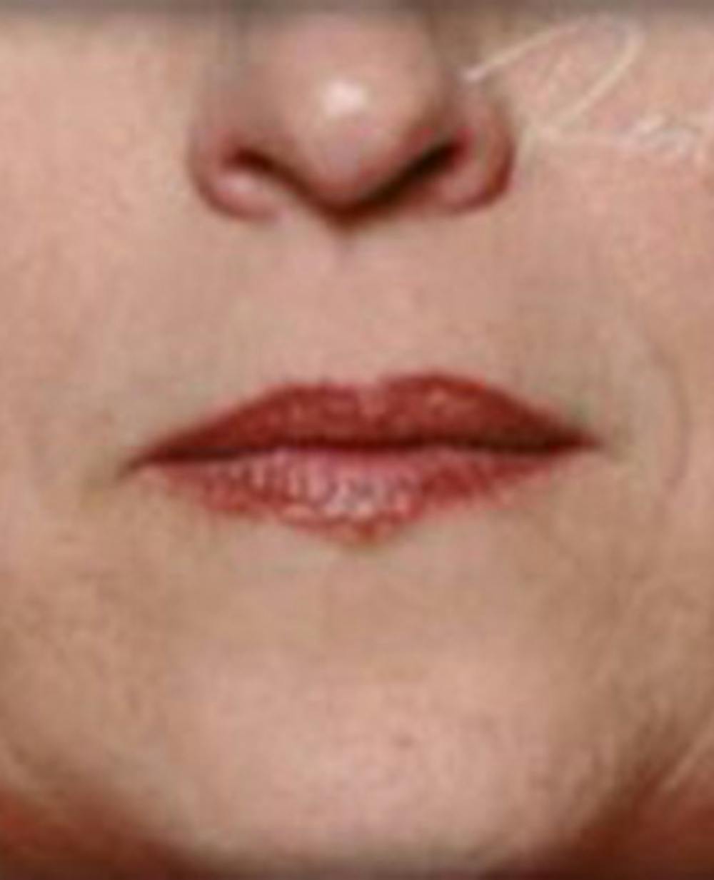 Lip Filler Before & After Gallery - Patient 870644 - Image 2