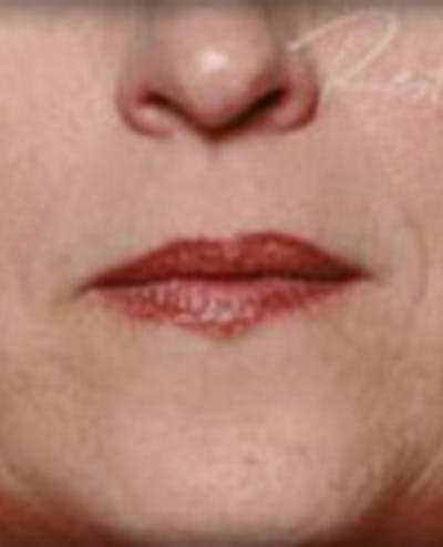 Lip Filler Before & After Gallery - Patient 870644 - Image 2
