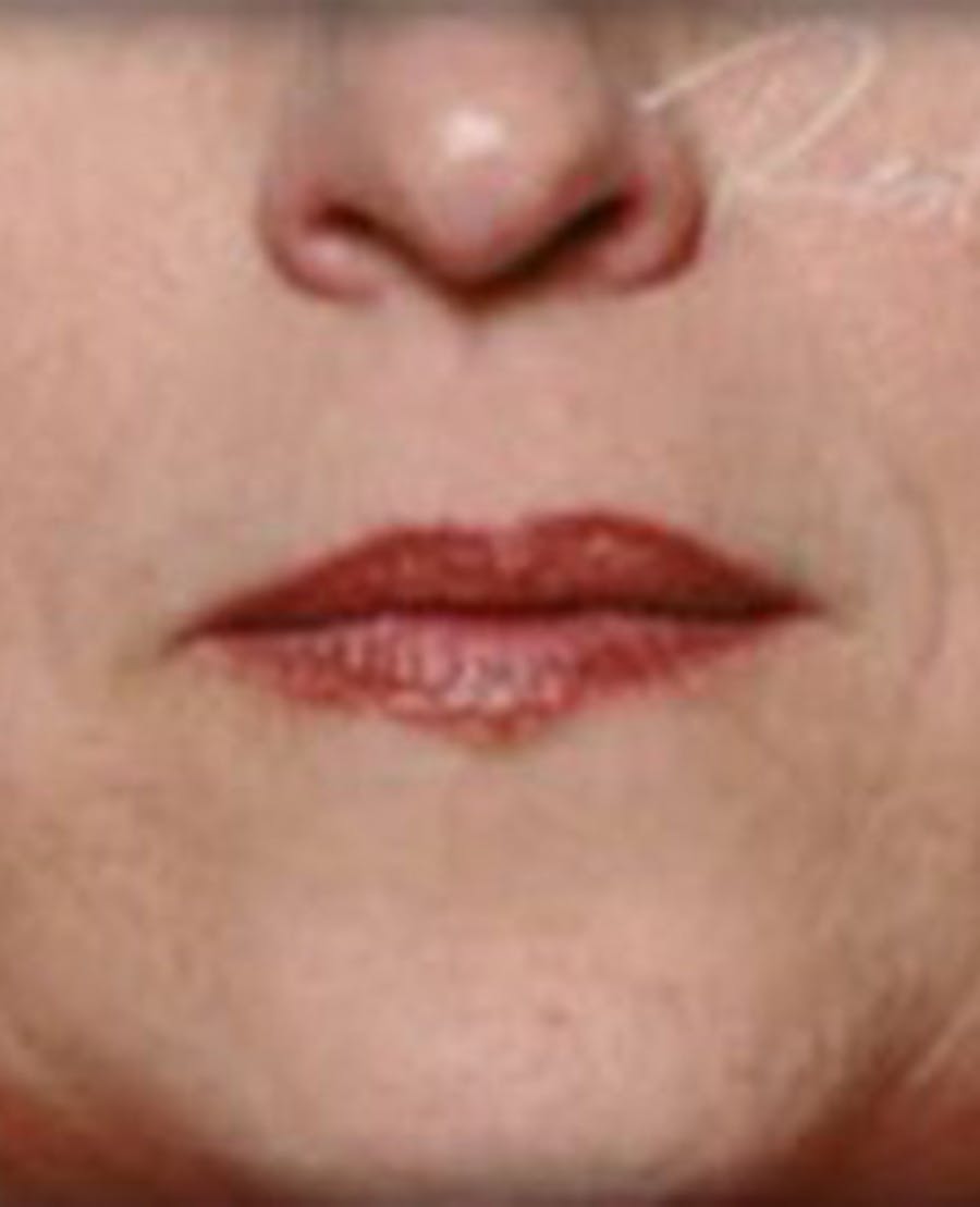 Lip Filler Before & After Gallery - Patient 870644 - Image 2