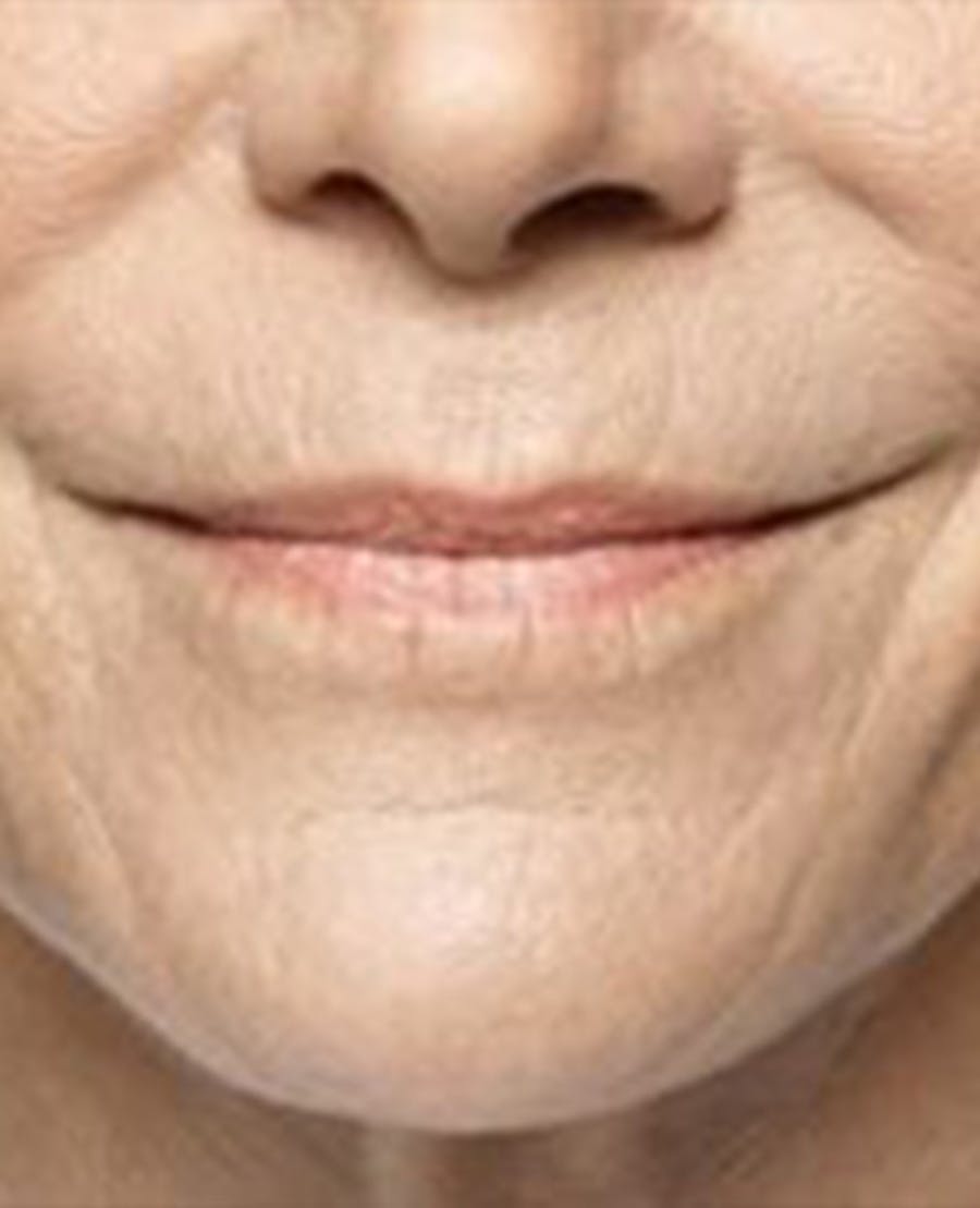 Lip Filler Before & After Gallery - Patient 395278 - Image 1