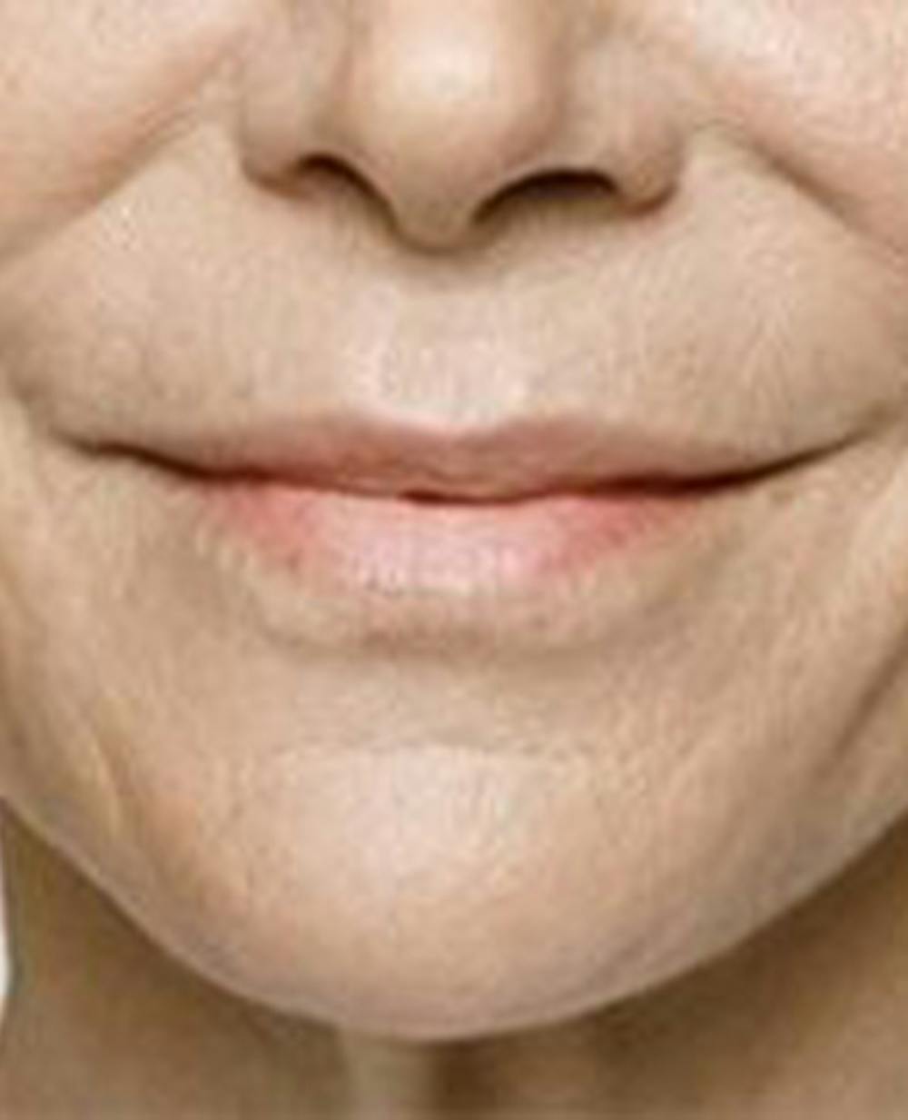 Lip Filler Before & After Gallery - Patient 395278 - Image 2