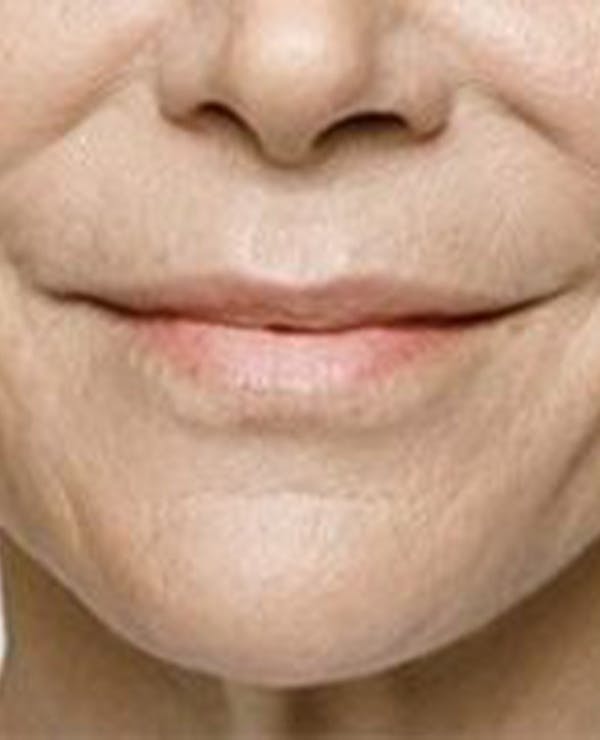 Lip Filler Before & After Gallery - Patient 395278 - Image 2