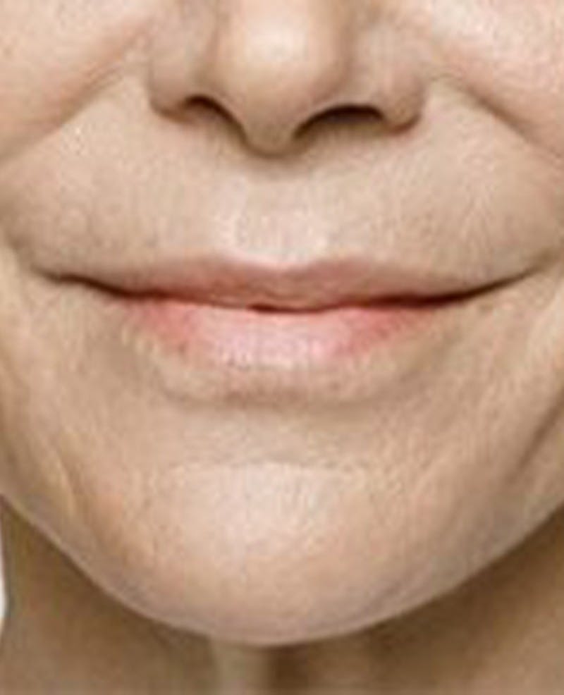 Lip Filler Before & After Gallery - Patient 395278 - Image 2