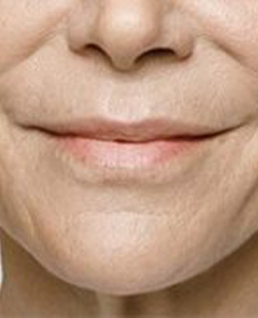 Lip Filler Before & After Gallery - Patient 395278 - Image 2