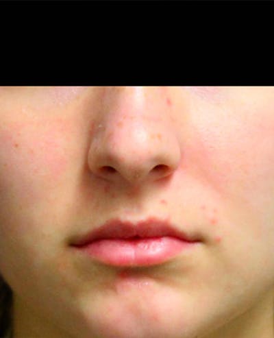 Lip Filler Before & After Gallery - Patient 143617244 - Image 1