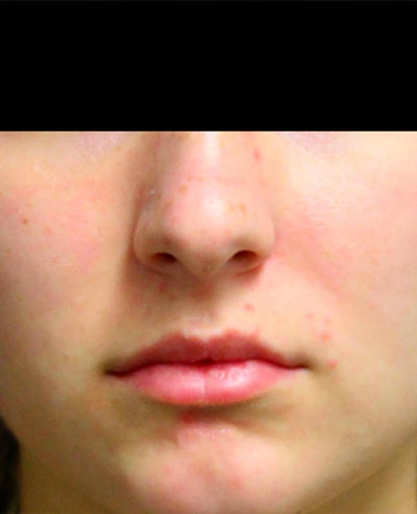 Lip Filler Before & After Gallery - Patient 143617244 - Image 1