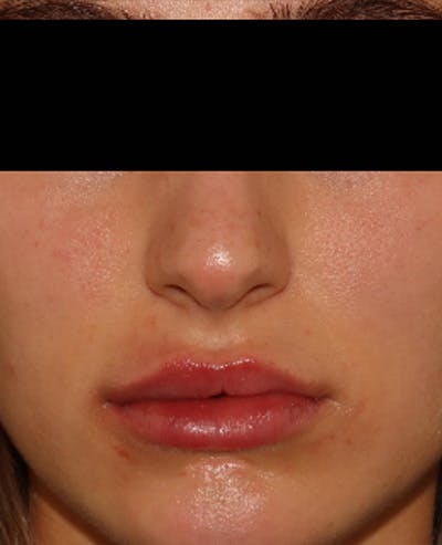 Lip Filler Before & After Gallery - Patient 143617244 - Image 2