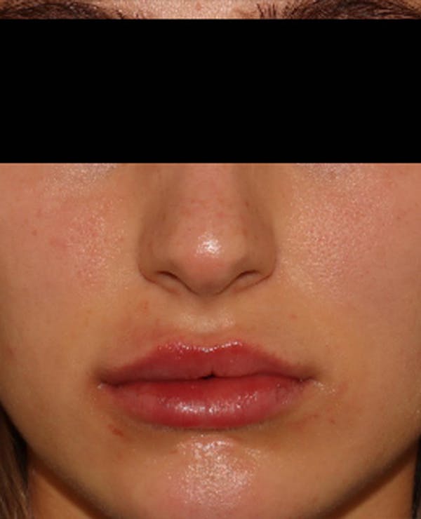Lip Filler Before & After Gallery - Patient 143617244 - Image 2