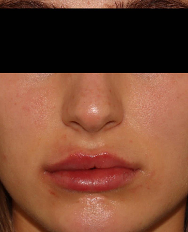 Lip Filler Before & After Gallery - Patient 143617244 - Image 2