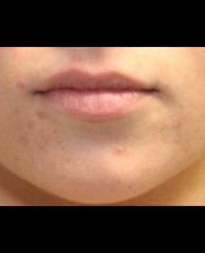 Lip Filler Before & After Gallery - Patient 390308 - Image 1