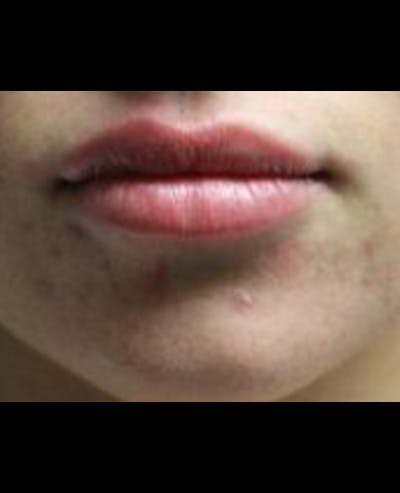 Lip Filler Before & After Gallery - Patient 390308 - Image 2
