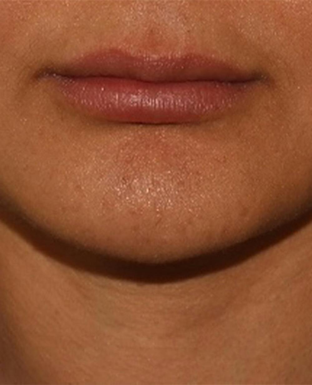 Lip Filler Before & After Gallery - Patient 143617245 - Image 1