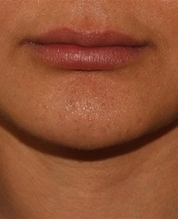 Lip Filler Before & After Gallery - Patient 143617245 - Image 1