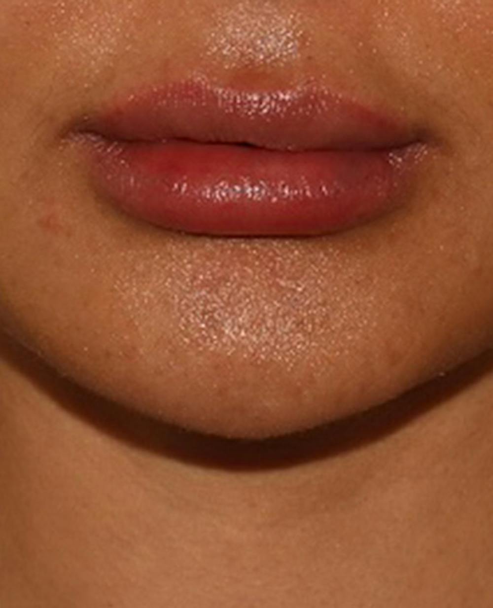 Lip Filler Before & After Gallery - Patient 143617245 - Image 2