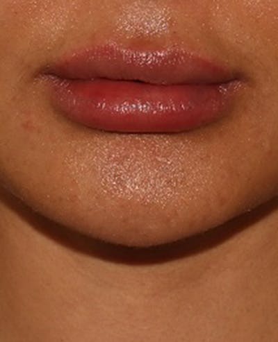 Lip Filler Before & After Gallery - Patient 143617245 - Image 2