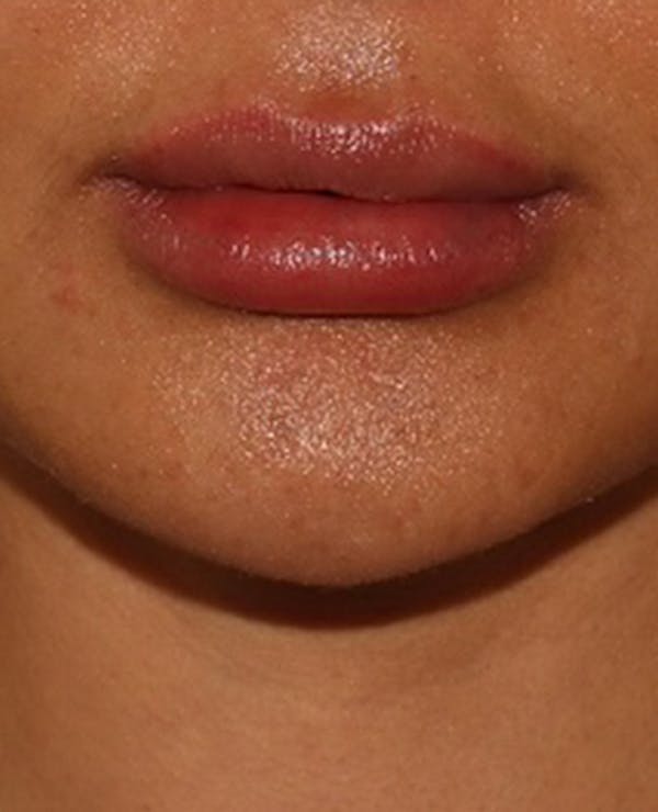 Lip Filler Before & After Gallery - Patient 143617245 - Image 2