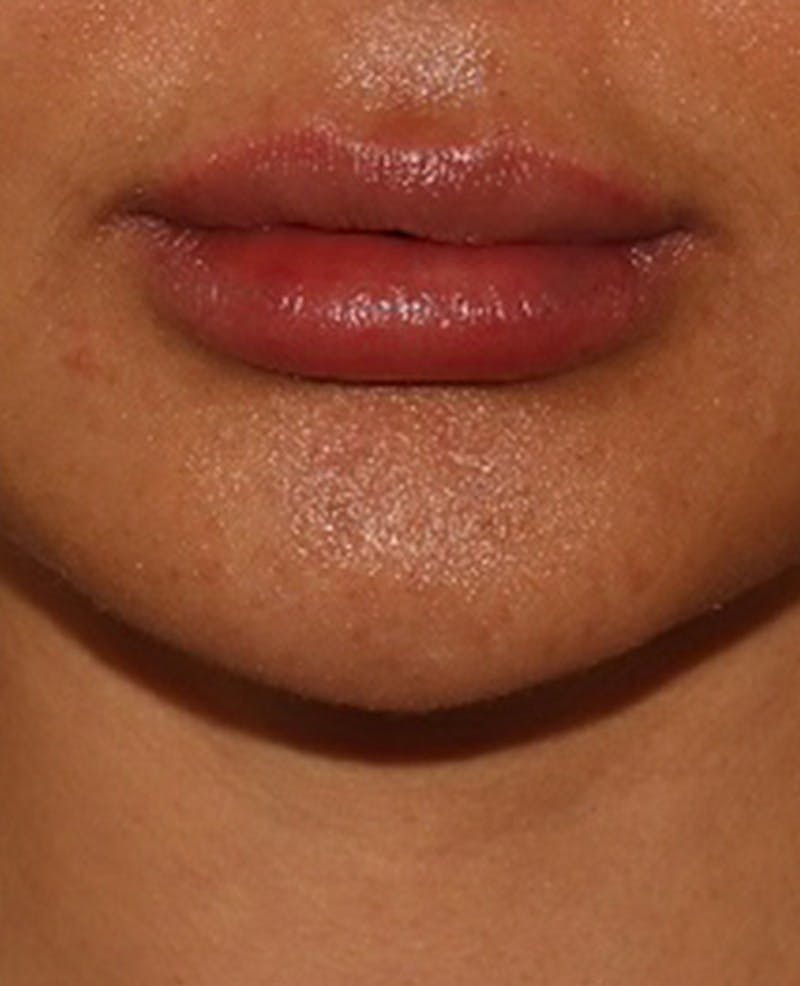Lip Filler Before & After Gallery - Patient 143617245 - Image 2
