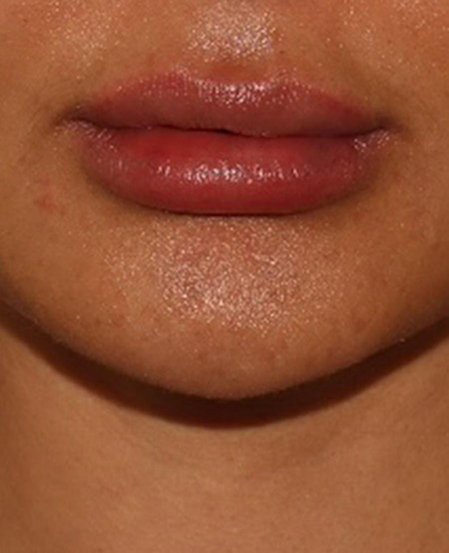 Lip Filler Before & After Gallery - Patient 143617245 - Image 2