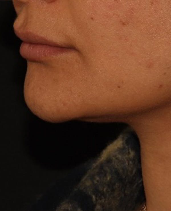 Lip Filler Before & After Gallery - Patient 143617245 - Image 3