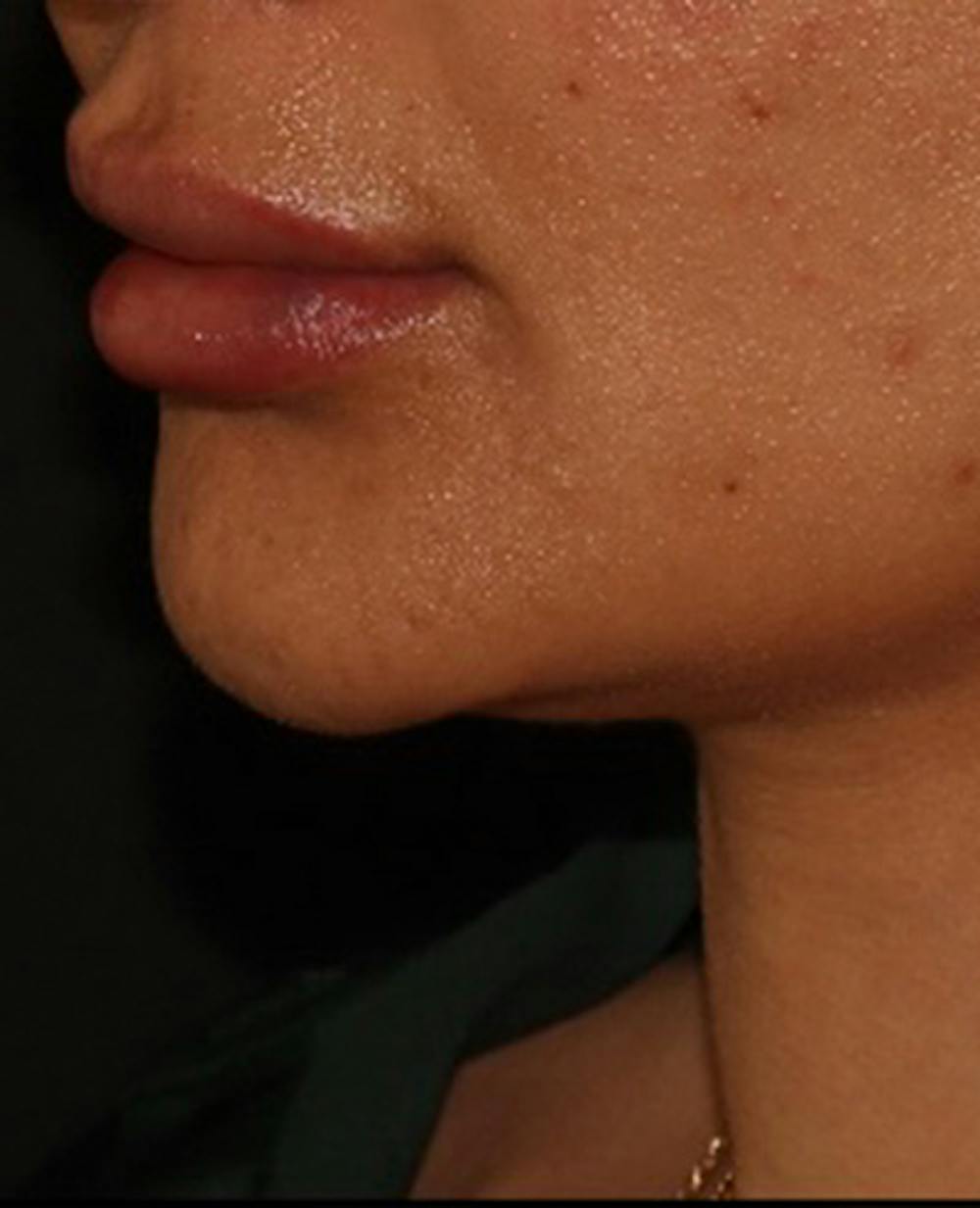 Lip Filler Before & After Gallery - Patient 143617245 - Image 4