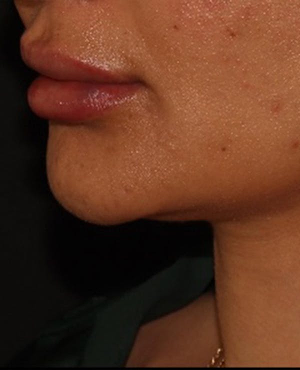 Lip Filler Before & After Gallery - Patient 143617245 - Image 4
