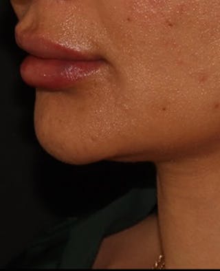 Lip Filler Before & After Gallery - Patient 143617245 - Image 4