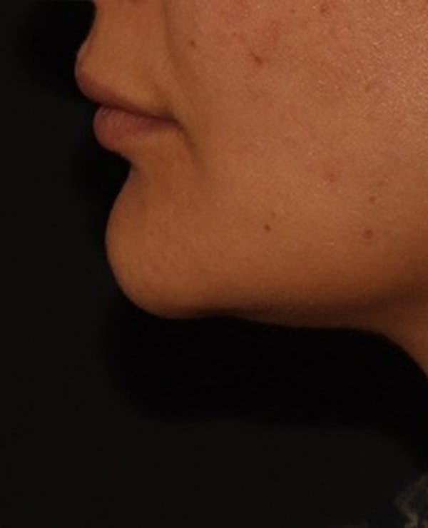 Lip Filler Before & After Gallery - Patient 143617245 - Image 5