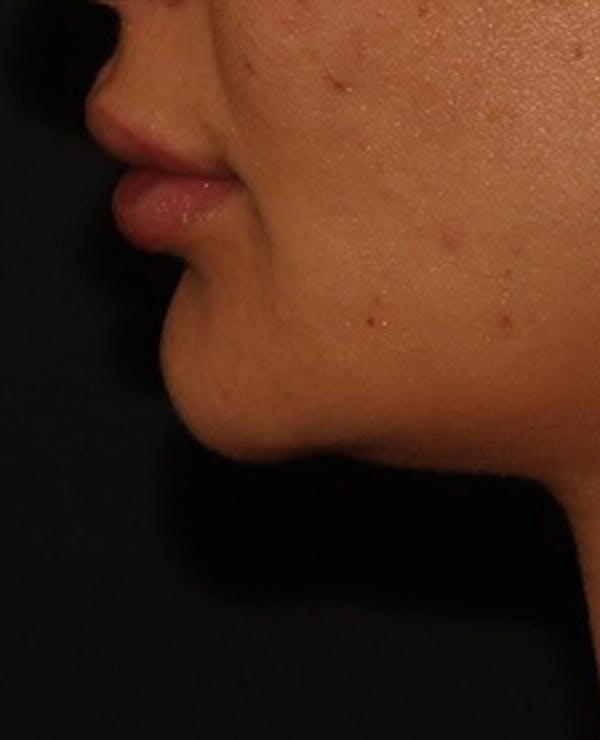 Lip Filler Before & After Gallery - Patient 143617245 - Image 6