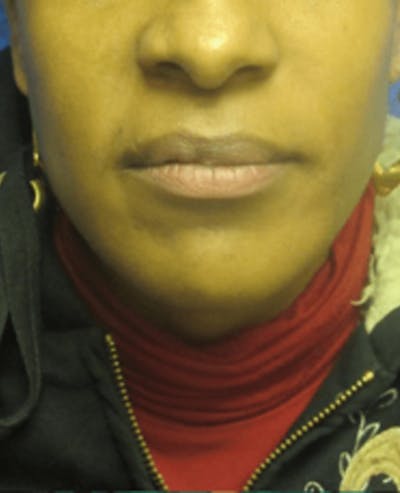 Lip Reduction Before & After Gallery - Patient 25274175 - Image 1