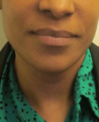 Lip Reduction Before & After Gallery - Patient 25274175 - Image 2