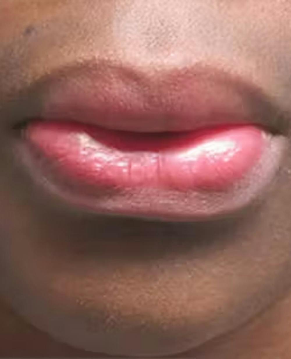 Lip Reduction Before & After Gallery - Patient 25274177 - Image 1