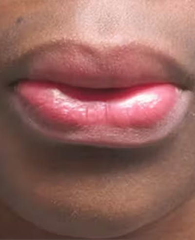 Lip Reduction Before & After Gallery - Patient 25274177 - Image 1