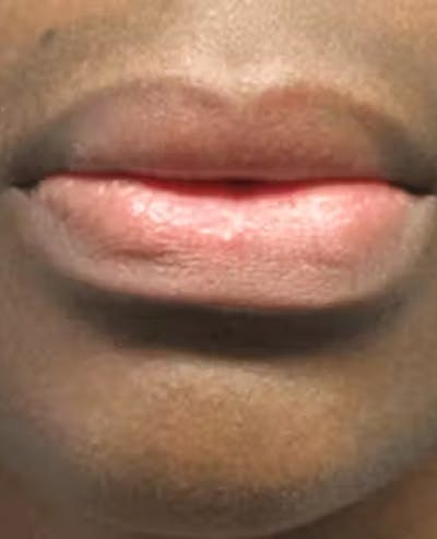Lip Reduction Before & After Gallery - Patient 25274177 - Image 2
