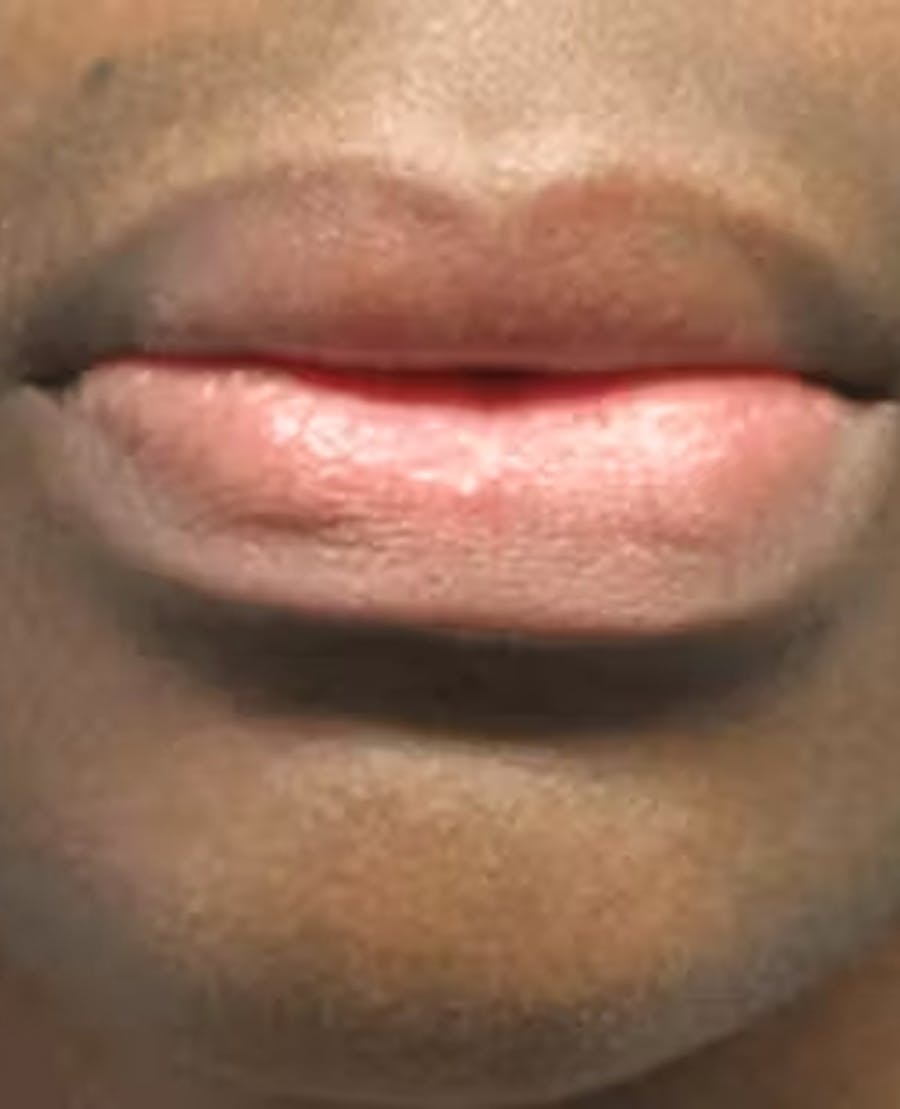 Lip Reduction Before & After Gallery - Patient 25274177 - Image 2