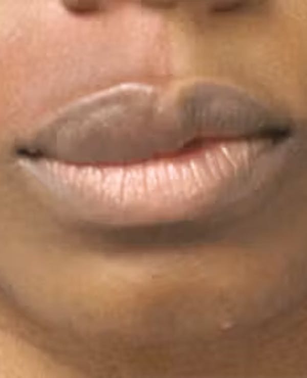 Lip Reduction Before & After Gallery - Patient 25274179 - Image 1