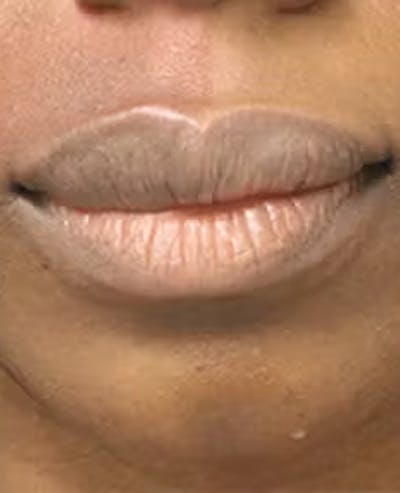 Lip Reduction Before & After Gallery - Patient 25274179 - Image 2