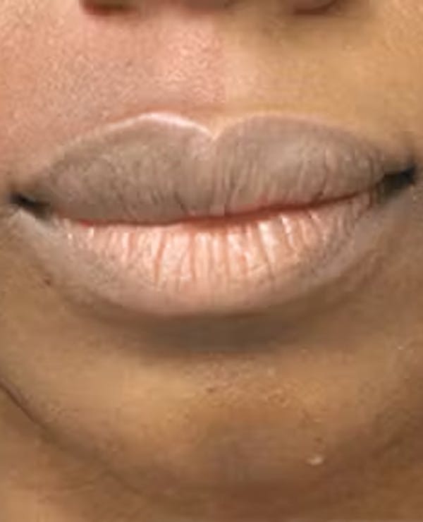 Lip Reduction Before & After Gallery - Patient 25274179 - Image 2