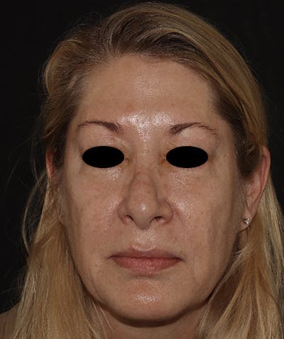 Rhinoplasty Before & After Gallery - Patient 123044001 - Image 1
