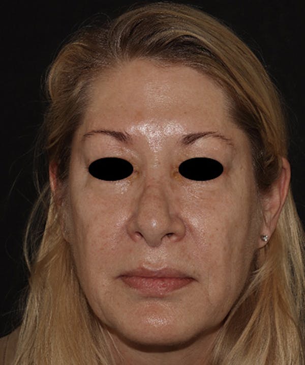 Rhinoplasty Before & After Gallery - Patient 123044001 - Image 1