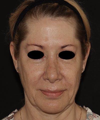 Rhinoplasty Before & After Gallery - Patient 123044001 - Image 2