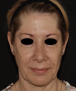 Rhinoplasty Before & After Gallery - Patient 123044001 - Image 4