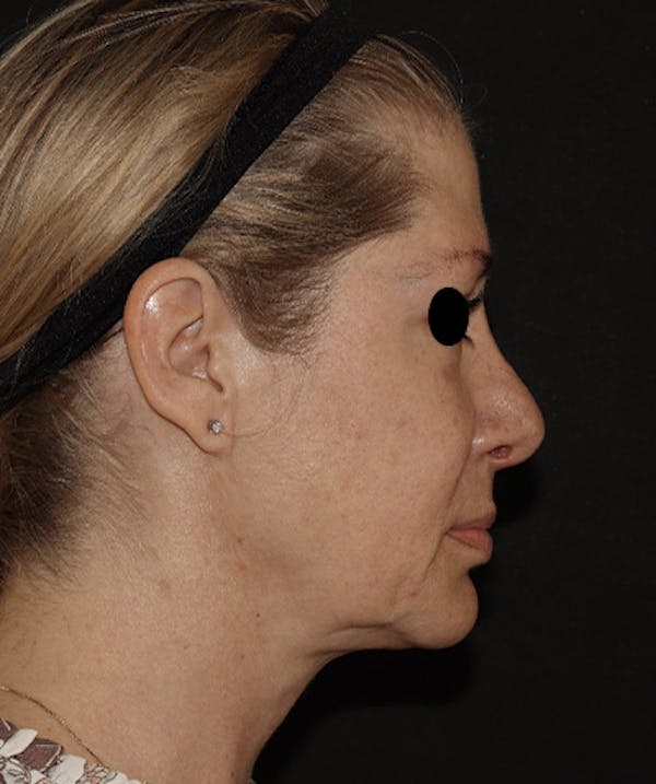 Rhinoplasty Before & After Gallery - Patient 123044001 - Image 4