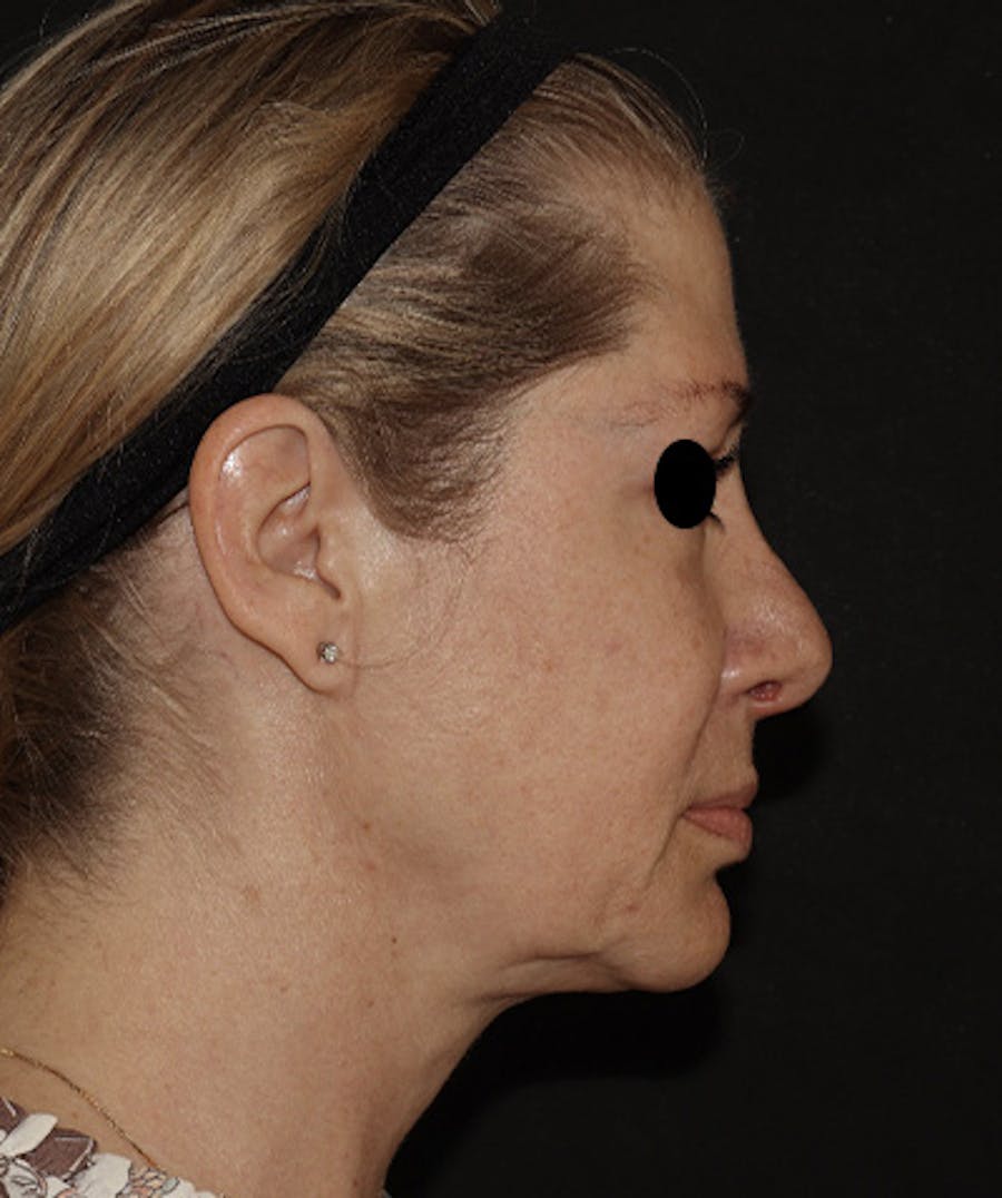 Rhinoplasty Before & After Gallery - Patient 123044001 - Image 4