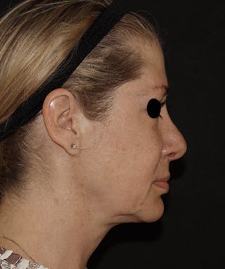 Rhinoplasty Before & After Gallery - Patient 123044001 - Image 2