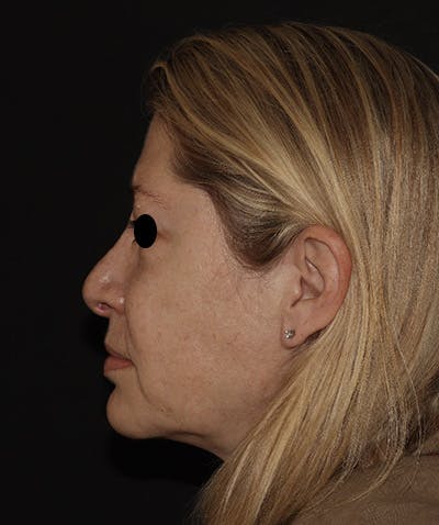 Rhinoplasty Before & After Gallery - Patient 123044001 - Image 5