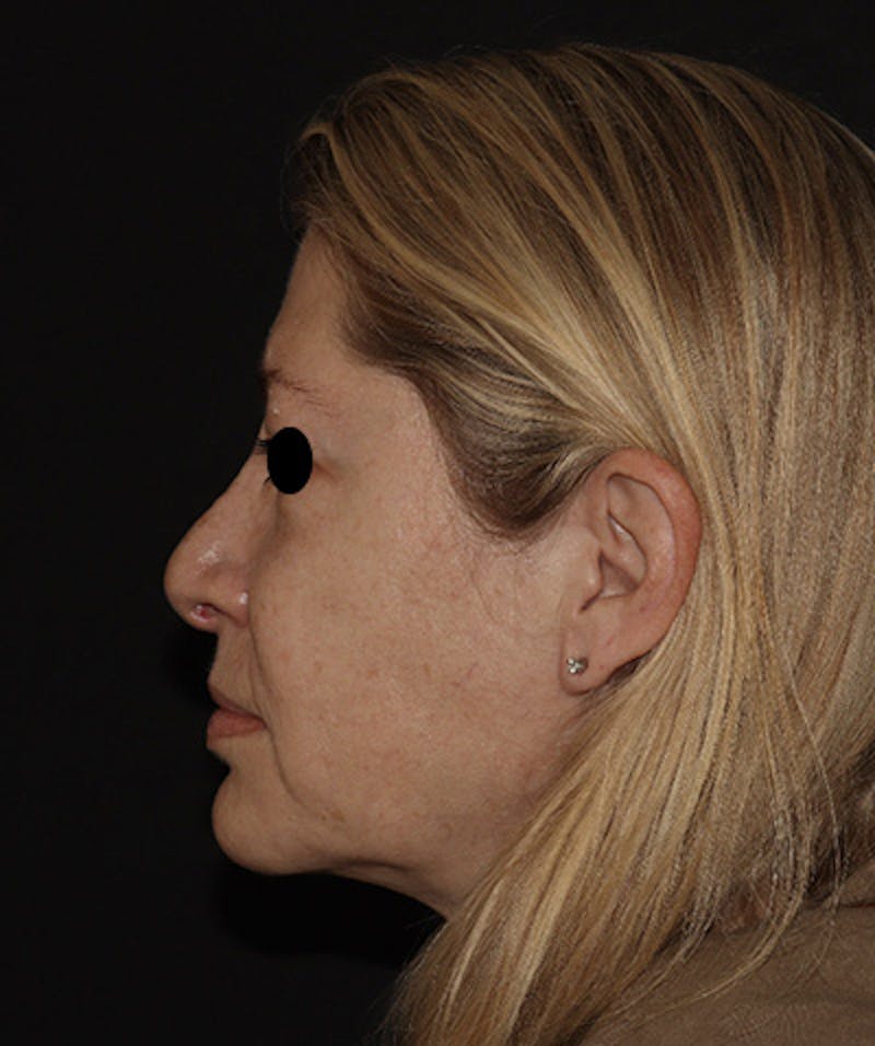Rhinoplasty Before & After Gallery - Patient 123044001 - Image 5