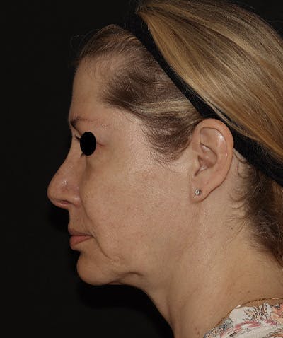 Rhinoplasty Before & After Gallery - Patient 123044001 - Image 6